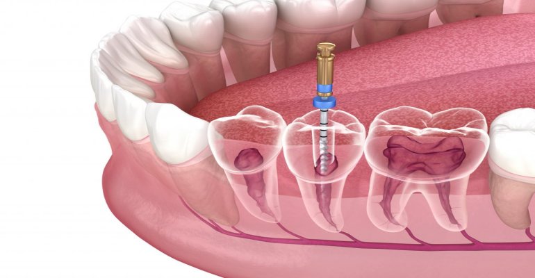 Knowing all about Root Canal Infection