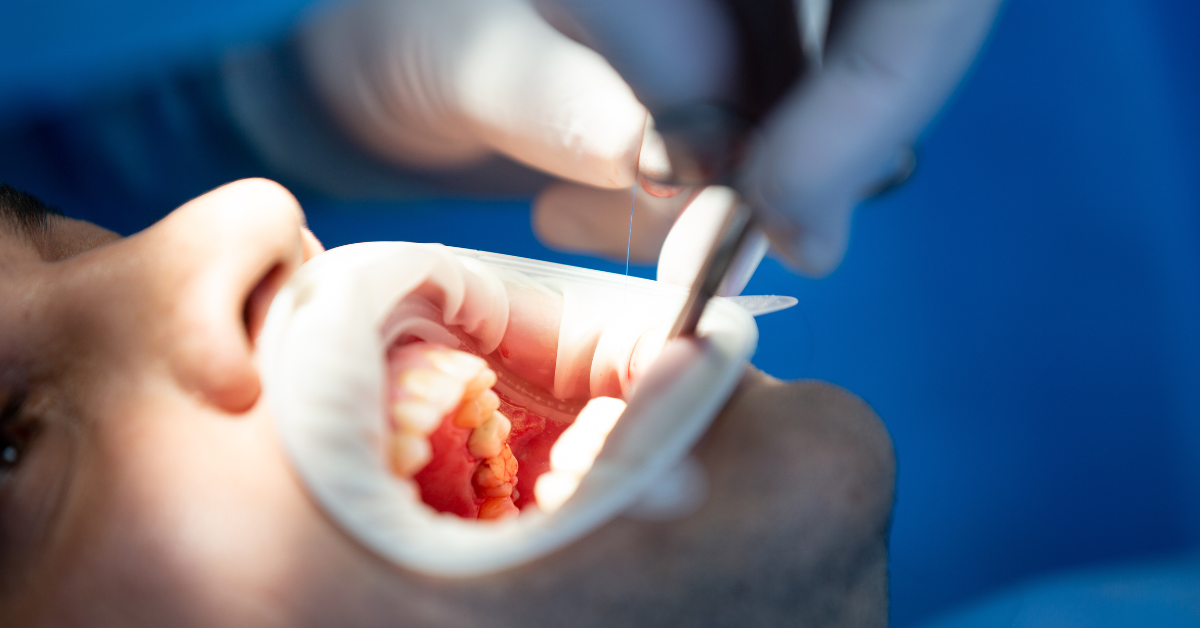 Dental Implant Cost in Mumbai, India