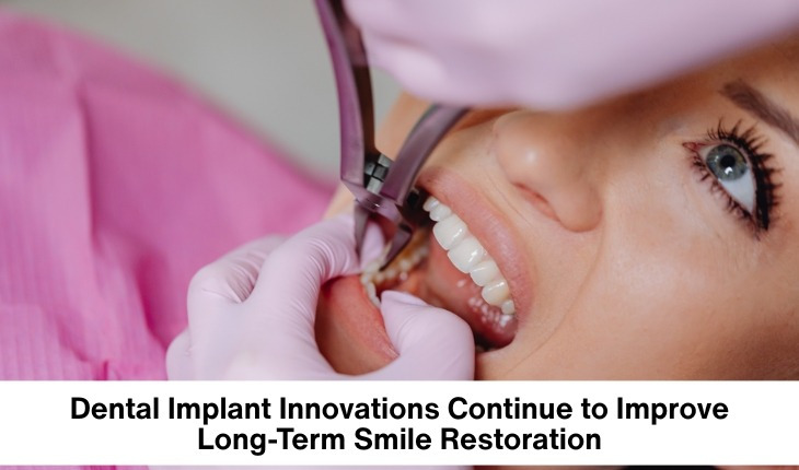 Dental Implant Innovations Continue to Improve Long-Term Smile Restoration